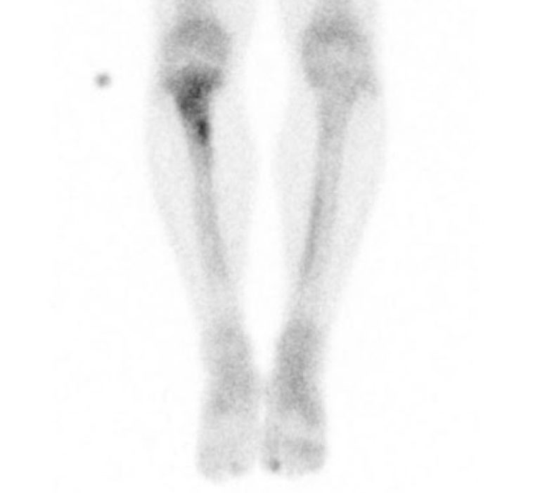 Case of the week: Tibial stress fracture and medial tibial stress ...