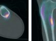 Linear increased uptake in the posteromedial tibial shaft