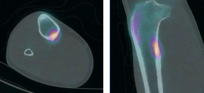 Linear increased uptake in the posteromedial tibial shaft