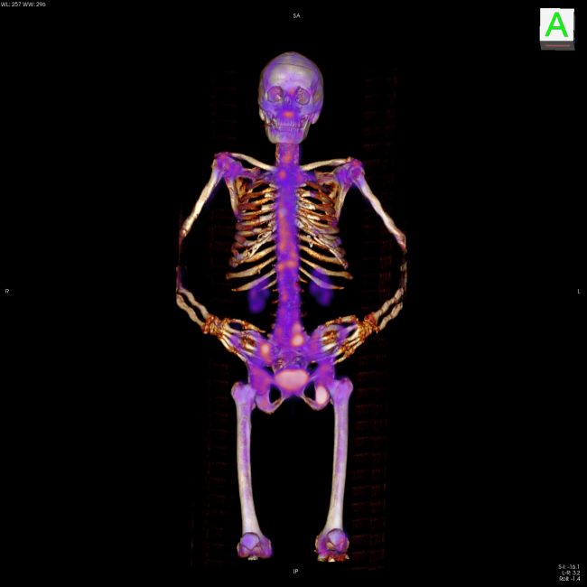 WB SPECT-CT