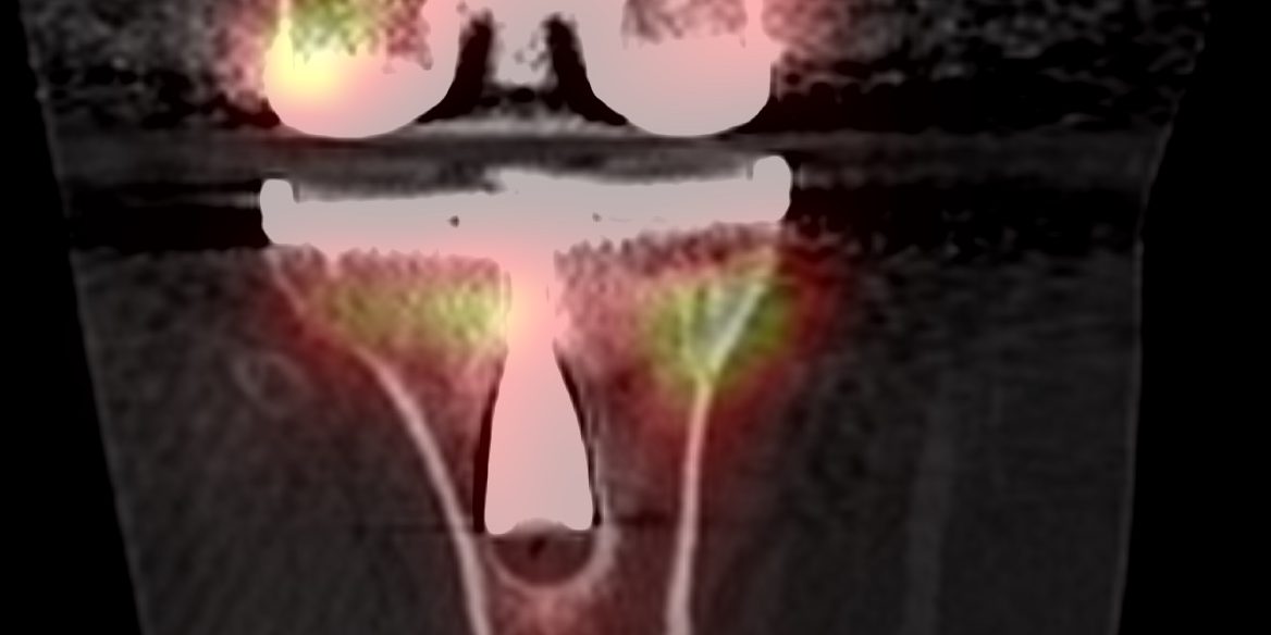 knee SPECT-CT