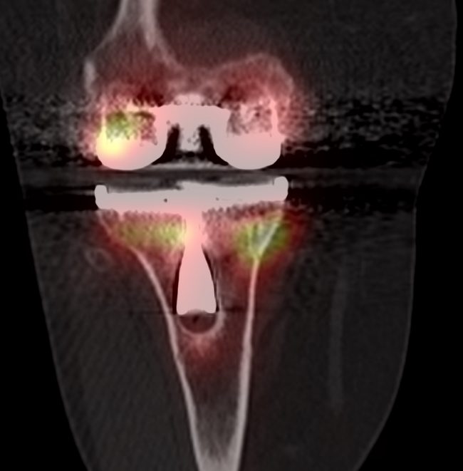 knee SPECT-CT