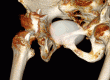 3D volume rendered image showing a hip replacement with impingement