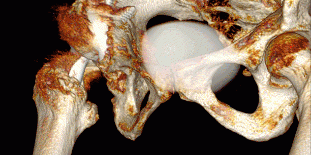 3D volume rendered image showing a hip replacement with impingement