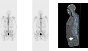 Nuclear Medicine Studies: Whole-Body Bone SPECT-CT Scans For Cancer ...